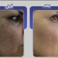 جشنواره رفع همیشگی کک ومک در۱ جلسه دونه ای۳۰ هزارت|خدمات آرایشگری و زیبایی|اصفهان, دشتستان|دیوار