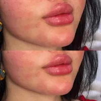 تزریق ژل لب.چانه.گونه.شقیقه