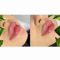 %50تخفیف پاییزی ژل،بوتاکس کلینیک سهندوهفده شهریور