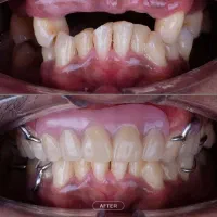 دندان مصنوعی قالب گیری در منزل|خدمات آرایشگری و زیبایی|کرج, کوی امامیه|دیوار