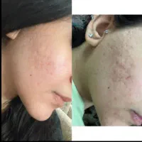 پاکسازی تخصصی پوست با دستگاه