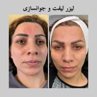جشنواره پاییزه لیزر موهای زائد الکس پلاس (شاتی)/لک|خدمات آرایشگری و زیبایی|رشت, گلسار|دیوار