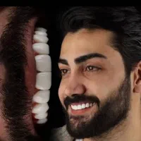 ثبت نام بیمه دندانپزشکی و کامپوزیت طلایی شو