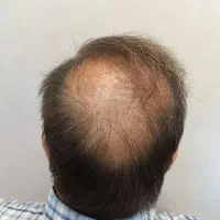 آموزش و خدمات میکرواسکالپ مکمل کاشت مو|خدمات آرایشگری و زیبایی|رشت, بوسار|دیوار