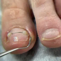خدمات ارتونیل(ارتودنسی ناخن)وکفسابی ،درمان میخچه|خدمات آرایشگری و زیبایی|تهران, دردشت|دیوار