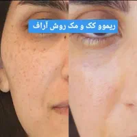 ریموو کک و مک تضمینی در کلینیک