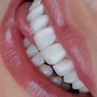 کامپوزیت دندان اقساطی بدون چک و ضامن|خدمات زیبایی و سلامت|تهران, جردن|دیوار