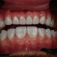 دندانپزشکی،کامپوزیت،لمینت،ایمپلنت فول دیجیتال قسطی