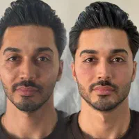 انجام و آموزش ژل بوتاکس جوان ساز پی ار پی