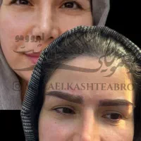 کاشت ابرو تخصصی در درمانگاه معتبر