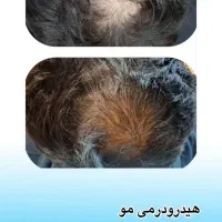 پاکسازی جوانسازی پوست و خالبرداری و مزو و بوتاکس|خدمات آرایشگری و زیبایی|سمنان, |دیوار