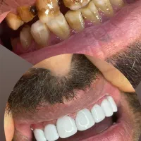 کامپوزیت دندان|خدمات آرایشگری و زیبایی|سبزوار, کاشفی شمالی (دادگستری)|دیوار