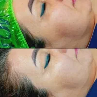 پاکسازی پوست(فیشال)