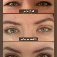 بلفاروپلاستی پلک با روش لیزری بدون رد بخیه|خدمات آرایشگری و زیبایی|تهران, پاسداران|دیوار