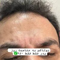 تزریق ژل بوتاکس مزوتراپی جوانسازی مشاوره رایگان