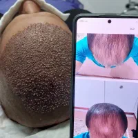 تخفیف ویژه کاشت مو و ابرو|خدمات آرایشگری و زیبایی|کرمانشاه, |دیوار