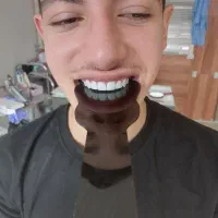 کامپوزیت دندان هر فک 5تومن|خدمات آرایشگری و زیبایی|محمدشهر, محمدشهر|دیوار