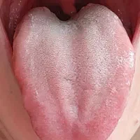 مزاجشناسی و تشخیص بیماری از روی زبان