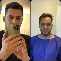آفر باورنکردنی کاشت‌مو/کاشت‌ابرو تضمینی یک‌روزه