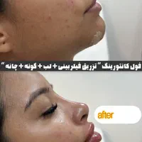 ژل و بوتاکس مرو فیلر توسط دکتر تخفیف ۳۰ ٪|خدمات آرایشگری و زیبایی|مشهد, کوثر|دیوار