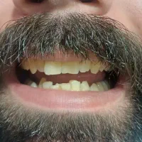 کامپوزیت دندان فکی ۸تومن|خدمات آرایشگری و زیبایی|تهران, والفجر|دیوار