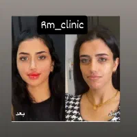 ۵۰ درصد تخفیف تزریق صورت سبک عربی هالیوودی لب روسی|خدمات آرایشگری و زیبایی|ری, دیلمان|دیوار