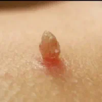 بهبود و کنترل زگیل تناسلی با مکملات کاملن گیاهی|آرایشی، بهداشتی، درمانی|گرگان, |دیوار