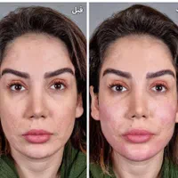 ژل وبوتاکس|خدمات آرایشگری و زیبایی|قم, شهرک فاطمیه|دیوار