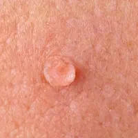 رفع ریشه ای و دائمی زگیل و تبخال عادی و تناسلی