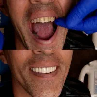 انجام لمینت متحرک دندان|خدمات آرایشگری و زیبایی|تهران, تهرانپارس غربی|دیوار