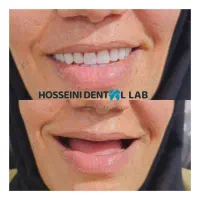 دندانسازی(بلوارهدایت)دندان مصنوعی/دندان سازی|خدمات آرایشگری و زیبایی|مشهد, هدایت|دیوار