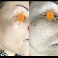 برداشتن انواع خال کک مک لک بادستگاه پیشرفته|خدمات آرایشگری و زیبایی|کازرون, |دیوار