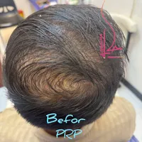 پی ار پی PRP ،مزوتراپی،اگزوزوم ولنجک،زعفرانیه|خدمات آرایشگری و زیبایی|تهران, محمودیه|دیوار