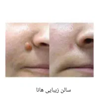برداشتن خال وزگیل وکک ومک گوشتی وریزبالیزر
