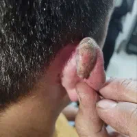 برداشتن خال زیگیل ومیخچه دست پابامحلول گیاهی