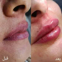تخفیف ویژه خدمات ژل و بوتاکس|خدمات آرایشگری و زیبایی|اهواز, سپیدار|دیوار