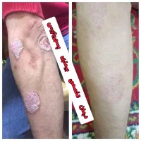 درمان ریشه ای و بدون بازگشت پیسی و پسوریازیس