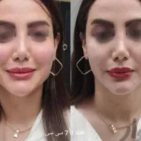 جشنواره50% ژل بوتاکس آنزیم خال مزو زگیل لابیا زگیل|خدمات آرایشگری و زیبایی|کرمانشاه, |دیوار