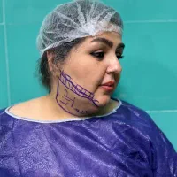 پیکرتراشی لیپو هر ناحیه فقط ۱۵ت