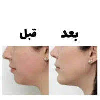 رفع غبغب با rf فقط با جلسه ای ۳۵۰ هزار تومن