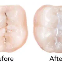 روکش و عصب کشی.ترمیم و پر کامپوزیت