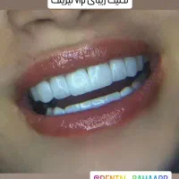 تخفیف ویژه عید کامپوزیت هرفک فقط ۹میلیون۹۰۰