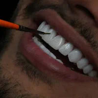 جشنواره کامپوزیت لمینیت عصب کشی روکش imax|خدمات آرایشگری و زیبایی|تهران, اقدسیه|دیوار