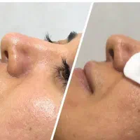 آموزش و خدمات تخصصی فیشیال مزوتراپی خالبرداری