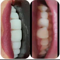 کامپوزیت در منزل. ایذه، باغملک، هفتکل|خدمات آرایشگری و زیبایی|ایذه, |دیوار