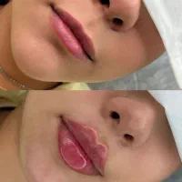 ژل بوتاکس سی سی ۱۱۰۰