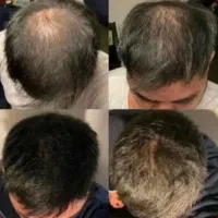 پرپشتی دائمی برای موهات