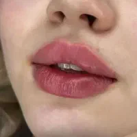 آموزش پیشرفته وتزریق ژل،بوتاکس ،پی ارپی،بایوفیلر