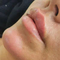 ژل و بوتاکس با قیمت باورنکردنی ترمیم رایگان|خدمات آرایشگری و زیبایی|کاشان, درب اصفهان|دیوار