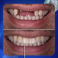 ایمپلنت / اقساط / بدون پیش پرداخت / ۶۰ ماهه